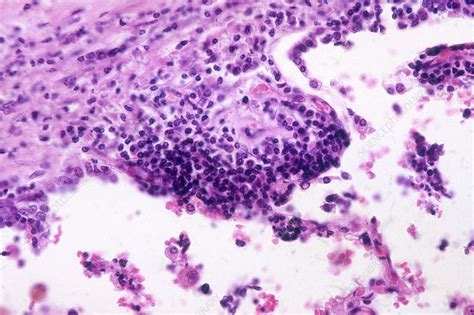 Oat Cell Carcinoma In Human Lung Lm Stock Image C017 6124 Science Photo Library