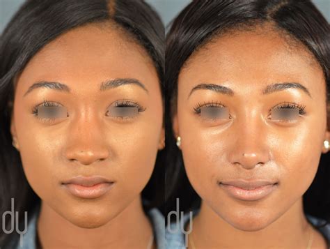 African American Liposuction Before And After Artvanlocationsinmichigan