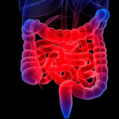 COLITIS ULCERATIVA ENFERMEDAD DE CROHN INFLAMACIÓN INTERSTINAL La