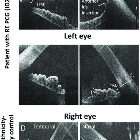 Horizontal High Resolution HH OCT Images Of The Temporal And Nasal