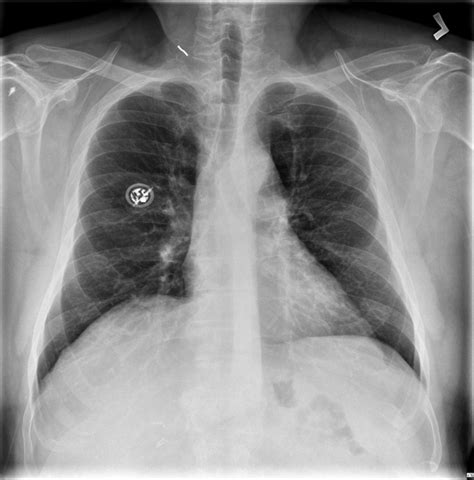 phrenic nerve palsy | pacs