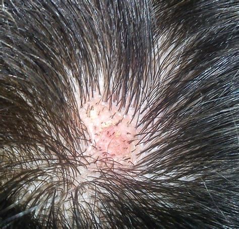 scalp acne cause - pictures, photos