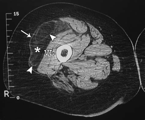 Imaging Of Musculoskeletal Liposarcoma With Radiologic Pathologic