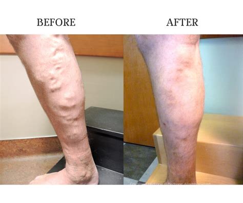 Best Treatment For Varicose Veins In Atlanta Ga Complete Guide