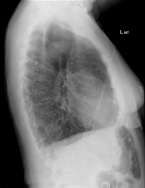 Labeled Lateral Chest X Ray