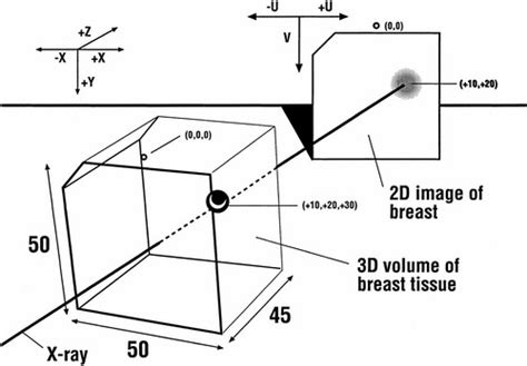 Stereotactic Localization Of Breast Lesions How It Works And Methods To Improve Accuracy