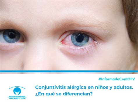 Conjuntivitis Al Rgica En Ni Os Y Adultos En Qu Se Diferencian