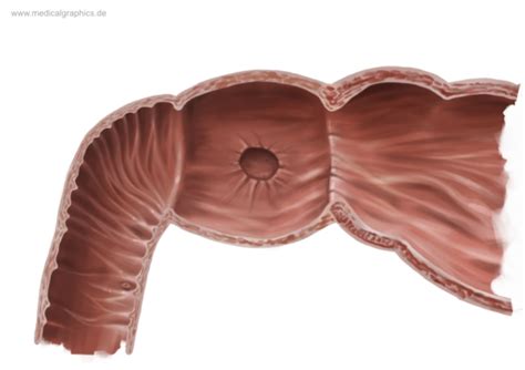 Kostenlose Illustration Ulcus Duodeni