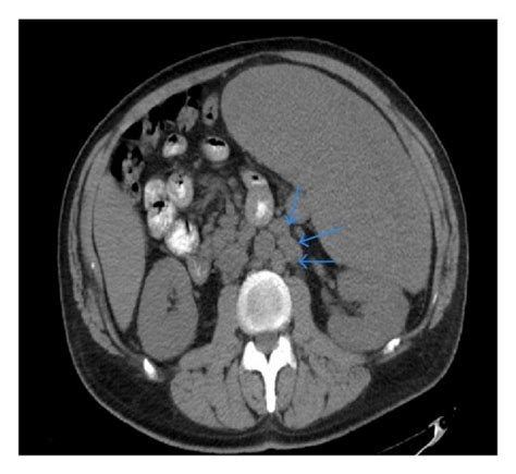 Massive Splenomegaly A Sagittal Sonographic View Of The Spleen