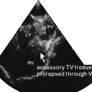 Two Dimensional Echocardiogram Showing Accessory Tricuspid Valve Tv