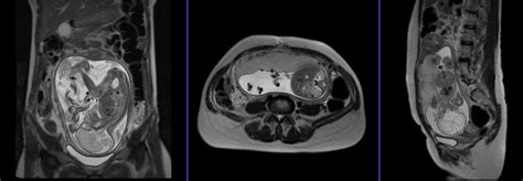 Fetal Brain MRI | Fetal Brain Scan Protocol and Planning