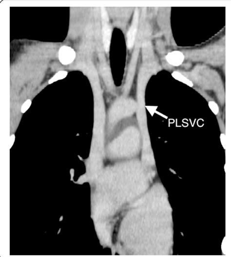 Preoperative Computed Tomography Shows Persistent Left Superior Vena Download Scientific