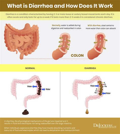 What causes diarrhea – Artofit