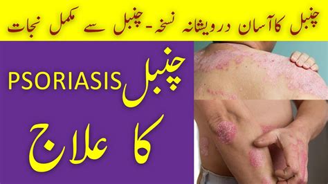 Chambal Psoriasis Treatment Urdu Hindi By Hakeem