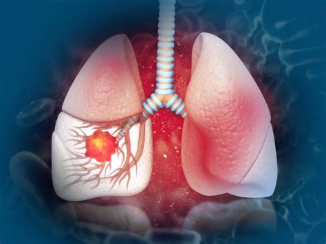 Fda Approval To Tremelimumab Plus Durvalumab With Chemotherapy For Nsclc Patients Bjmo