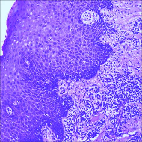 Histological Section Showing Hyperplastic Parakeratinized Epithelium