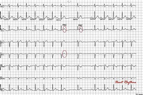 Ecg Rhythms Atypical Wenckebach Interrupted By Bigeminal Pac S