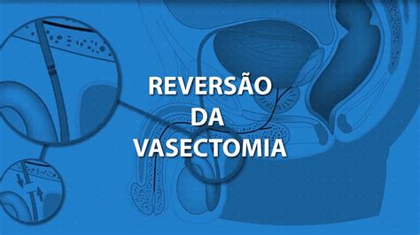 Como é A Recuperação Da Vasectomia