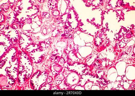 Hyperplasie De La Prostate Photomicrographe Montrant Les Glandes