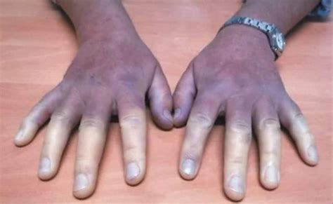 Asi Es La Enfermedad De Raynaud El Fenomeno De Los Dedos Blancos Otosection