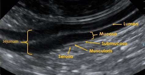 Gastroesophageal Junction Ultrasound