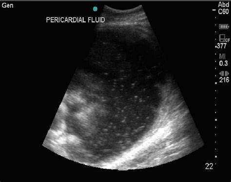 Hyperechoic Dots Indicates Presence Of Fibrinous And Purulent Exudate