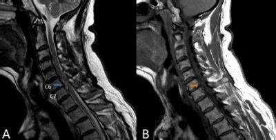 H Rnia De Disco Cervical O Que Sintomas E Tratamentos Em Lisboa