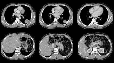 Top Ct Images Show Multiple Intrathoracic But Extrapulmonary Enhancing