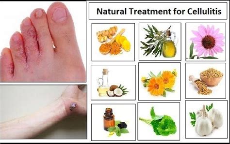 Natural Treatment For Cellulitis Using With Herbal Properties Cellulitis Treatment Natural