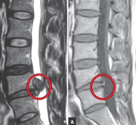 Can I recover from a slipped disc | The Physios Sheffield