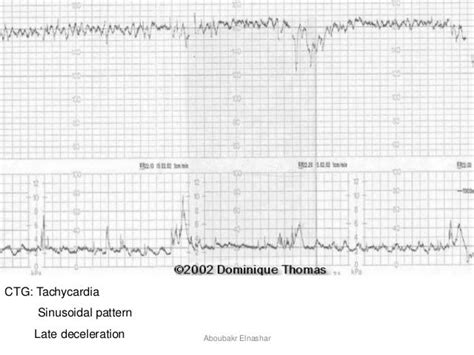 Cardiotocography Ctg Antepartum And Intrapartum