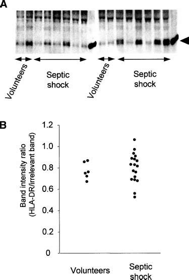 A Surface Expression Of Hla Dr Of Circulating Monocytes From