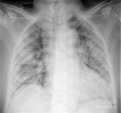 Chest X-ray Of Covid 19 Pneumonia Photograph by Rajaaisya/science Photo ...