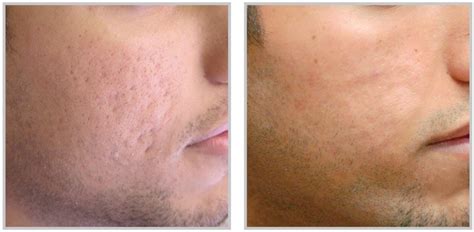 Prp Injection Before After Platelet Rich Plasma Reviews