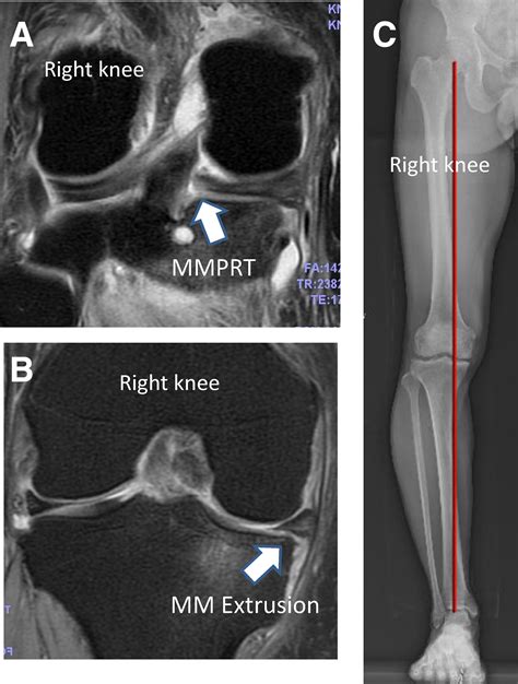 Combined Procedure Of Arthroscopic Pullout Medial Meniscal Root Repair