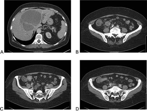 Metastatic Carcinoid Tumour Mimicking Cholecystitis And A Rare Case Of Intussusception Bmj