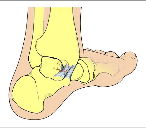 Figure 4 From Posterior Ankle Impingement Semantic Scholar