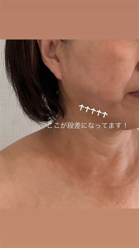 50代60代の頬顎脂肪吸引と糸リフトのコンビネーション治療で気を付けてほしいこと！ 脂肪吸引後のダウンタイム専門サロン Kmk