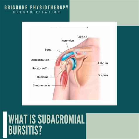 What is Subacromial Bursitis? - Brisbane Physiotherapy