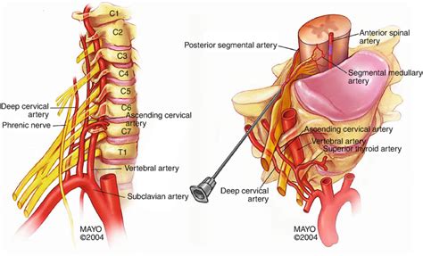 Cervical Nerve Root Block | Anesthesia Key