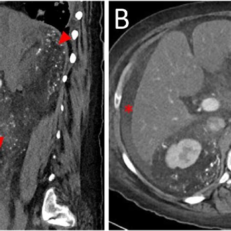 Computed Tomography Of The Abdomen And Pelvis Without And With Download Scientific Diagram