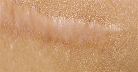 Keloid Scar Treatment Laser Treatment And Hypertrophic Scar Flattening