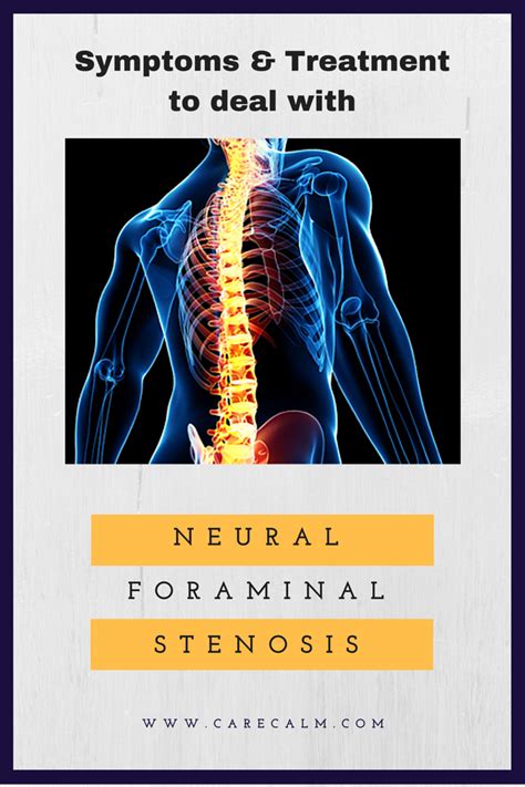 NEURAL FORAMINAL STENOSIS- SYMPTOMS & TREATMENT – Healthy Lifestyle Tips