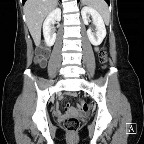 Coronal Section Of A Contrasted Computed Tomography Of The Abdomen And