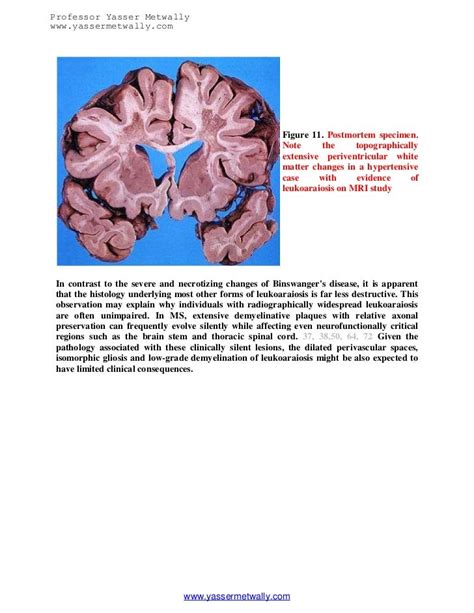 Radiological Pathology Of Ischemic Microvascular Brain Diseasean Upd