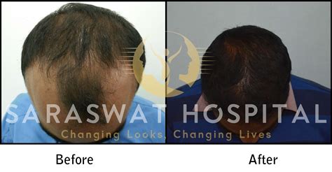 Hair Transplantation Before And After Results Saraswat Hospital