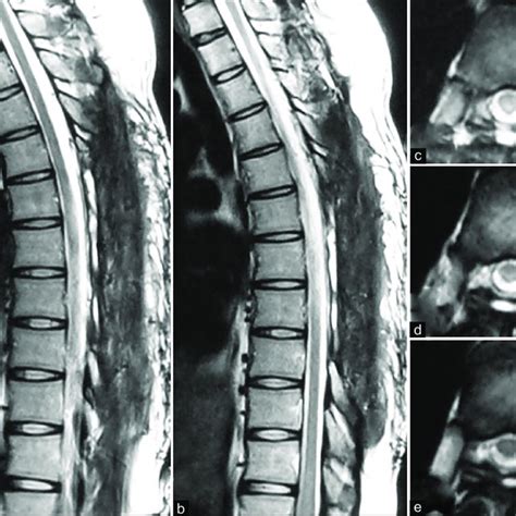 Magnetic Resonance Imaging Of The Thoracic Spine Obtained 6 Months Download Scientific Diagram