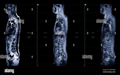 An MRI Of The Whole Spine Image Is A Comprehensive Visual