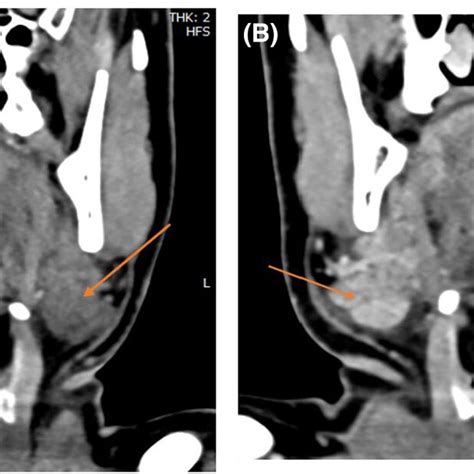 A Plain Ct Coronal Shows Mildly Enlarged Bilateral Submandibular