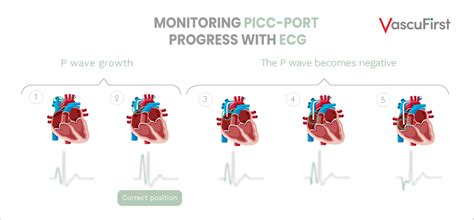 Measures To Ensure The Proper Functioning Of A Picc Port Vascufirst